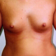 Breast Augmentation Greensboro NC